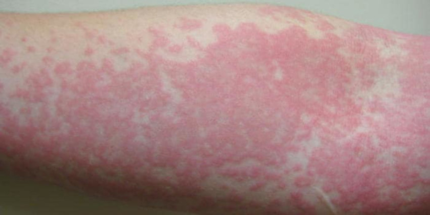 Dermatite da sudore - Oxiuros y anemia